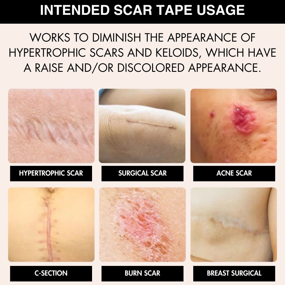 SCARSOOTHE SILICONE PATCHES